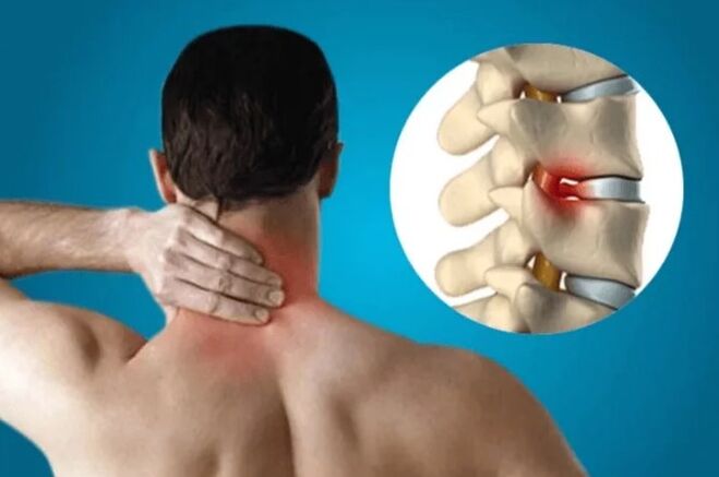 Osteochondroza kręgosłupa