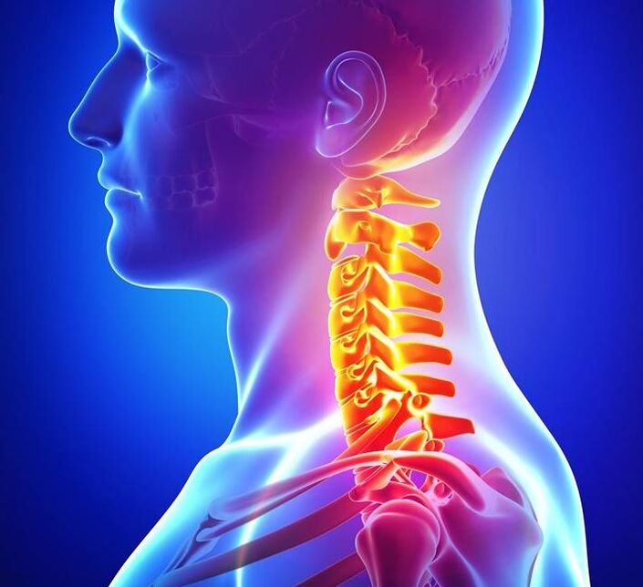 Osteochondroza odcinka szyjnego kręgosłupa
